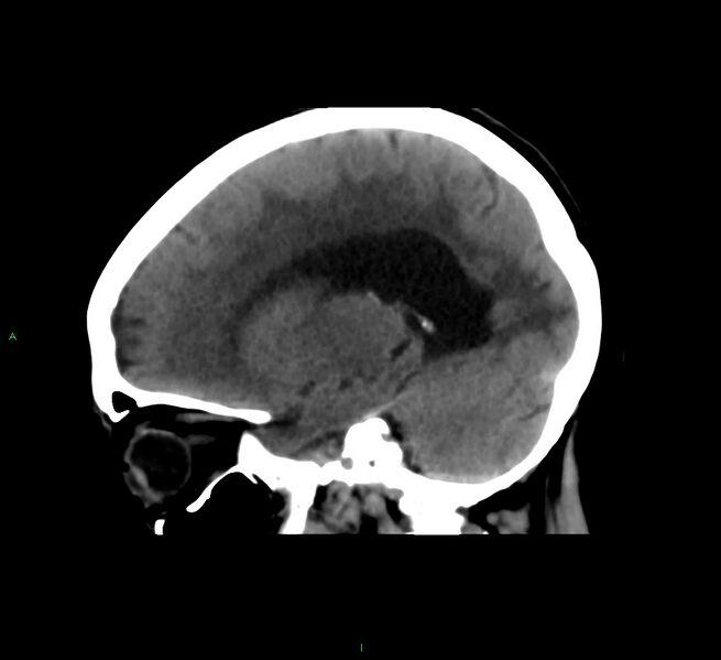 File:Cerebral amyloid angiopathy-associated lobar intracerebral hemorrhage (Radiopaedia 58561-65724 C 18).jpg