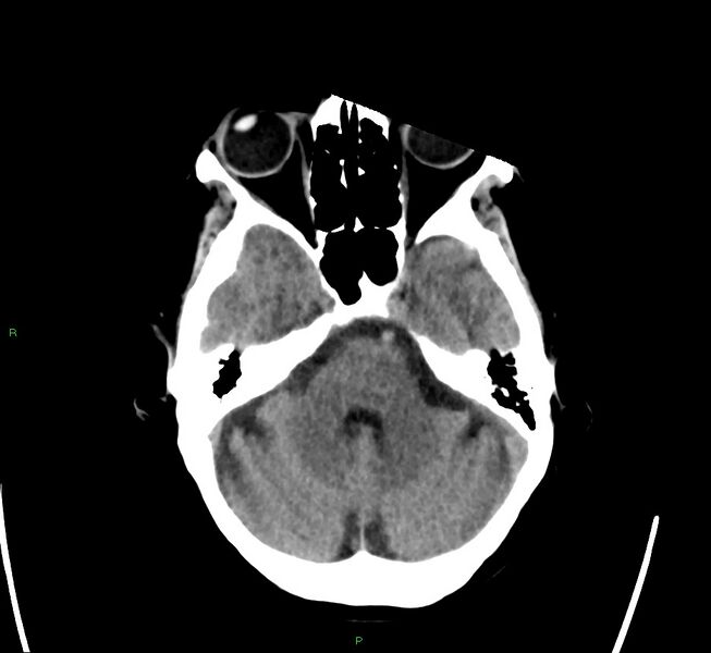 File:Cerebral amyloid angiopathy-associated lobar intracerebral hemorrhage (Radiopaedia 58563-65727 Axial non-contrast 40).jpg