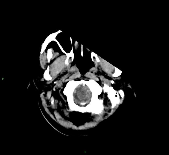 File:Cerebral amyloid angiopathy-associated lobar intracerebral hemorrhage (Radiopaedia 58566-65730 Axial non-contrast 47).jpg