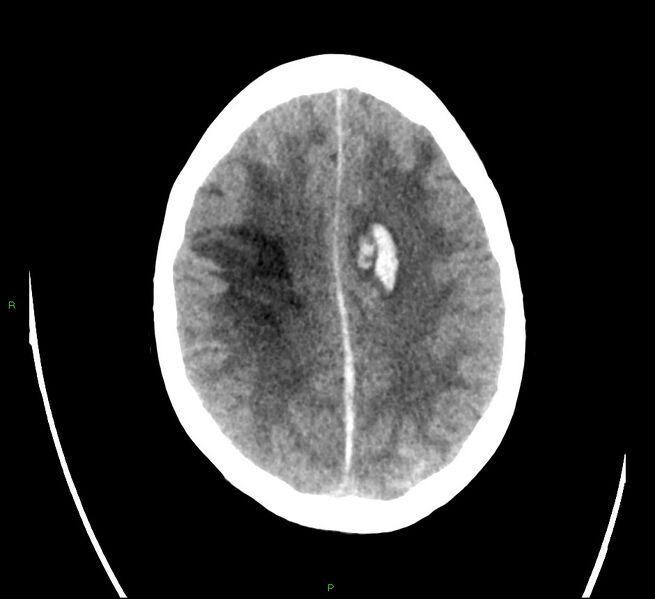File:Cerebral amyloid angiopathy-associated lobar intracerebral hemorrhage (Radiopaedia 58566-65731 Axial non-contrast 18).jpg
