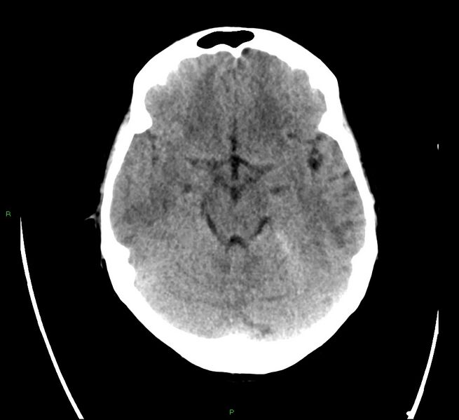 File:Cerebral amyloid angiopathy-associated lobar intracerebral hemorrhage (Radiopaedia 58566-65731 Axial non-contrast 9).jpg