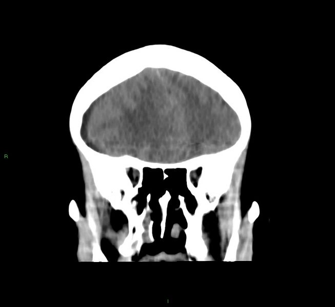 File:Cerebral amyloid angiopathy-associated lobar intracerebral hemorrhage (Radiopaedia 58751-65972 Coronal non-contrast 45).jpg