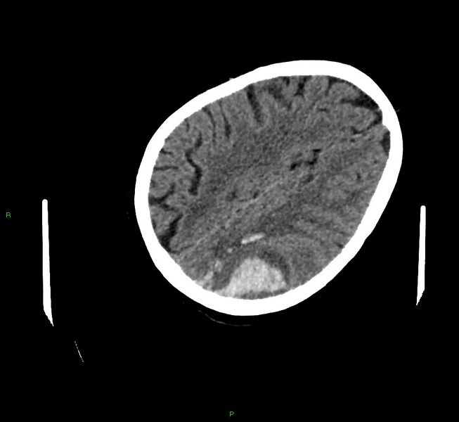 File:Cerebral amyloid angiopathy-associated lobar intracerebral hemorrhage (Radiopaedia 58757-65979 Axial non-contrast 100).jpg