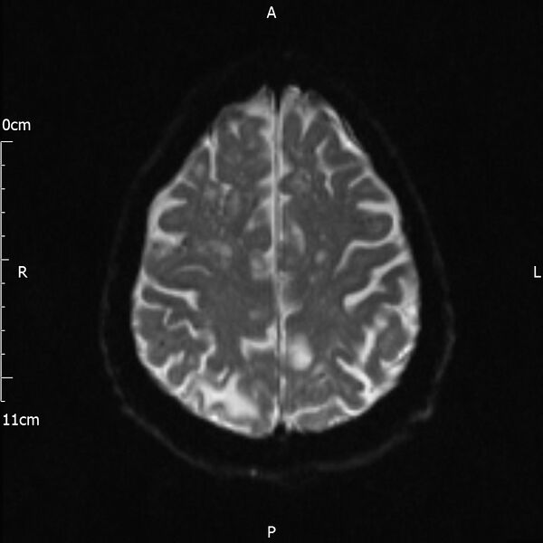 File:Cerebral amyloid angiopathy related inflammation (Radiopaedia 72772-83415 Axial DWI 18).jpg
