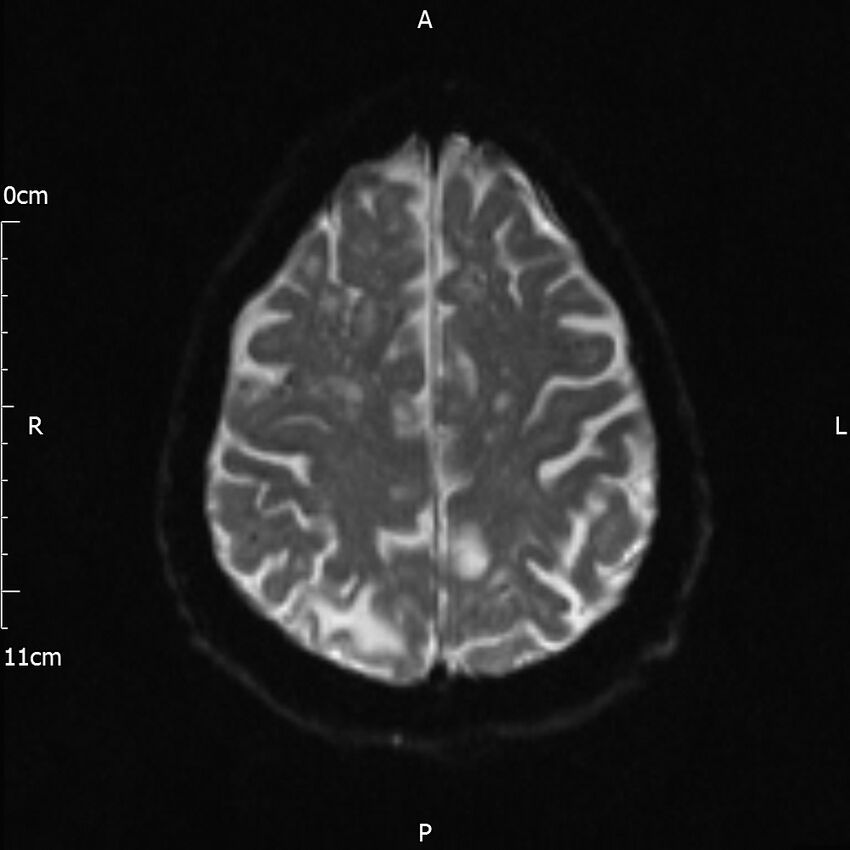 Cerebral amyloid angiopathy related inflammation (Radiopaedia 72772-83415 Axial DWI 18).jpg