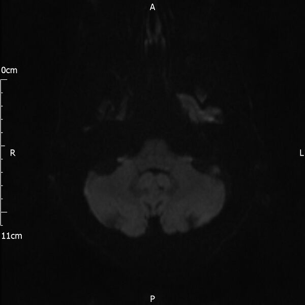 File:Cerebral amyloid angiopathy related inflammation (Radiopaedia 72772-83415 Axial DWI 52).jpg