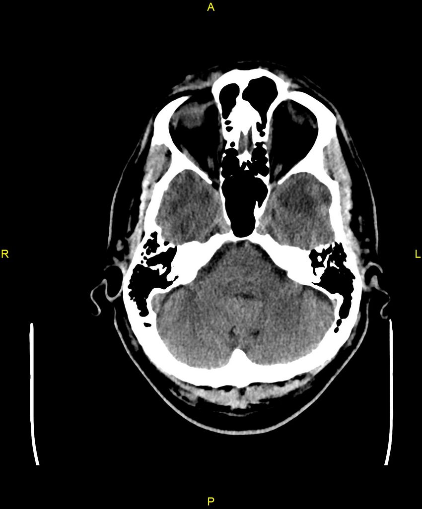 Cerebral autosomal dominant arteriopathy with subcortical infarcts and leukoencephalopathy (CADASIL) (Radiopaedia 86108-102051 Axial non-contrast 23).jpg