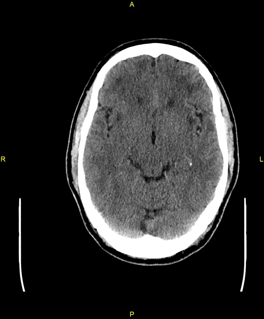 Cerebral autosomal dominant arteriopathy with subcortical infarcts and leukoencephalopathy (CADASIL) (Radiopaedia 86108-102051 Axial non-contrast 44).jpg