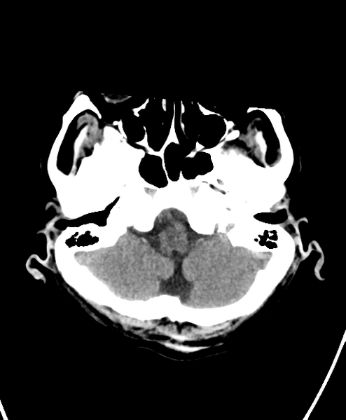 File:Cerebral contusions, subarachnoid hemorrhage and subdural hygromas (Radiopaedia 55399-61828 Axial non-contrast 5).png