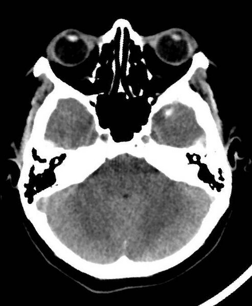 File:Cerebral edema due to severe hyponatremia (Radiopaedia 89826-106937 Axial non-contrast 21).jpg