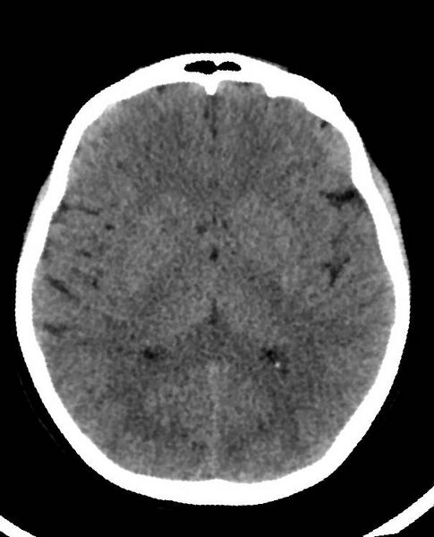 File:Cerebral edema due to severe hyponatremia (Radiopaedia 89826-106938 Axial non-contrast 54).jpg