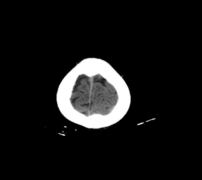 File:Cerebral fat embolism (Radiopaedia 37510-39362 Axial non-contrast 31).jpg