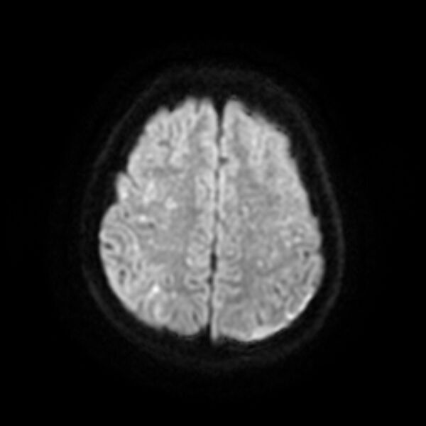 File:Cerebral fat embolism (Radiopaedia 37510-39363 Axial DWI 20).jpg
