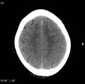 Cerebral hemorrhagic contusion with subdural and subarachnoid hemorrhage (Radiopaedia 10680-11146 Axial non-contrast 20).jpg