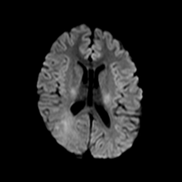 File:Cerebral tuberculoma (Radiopaedia 41152-43932 Axial DWI 13).jpg