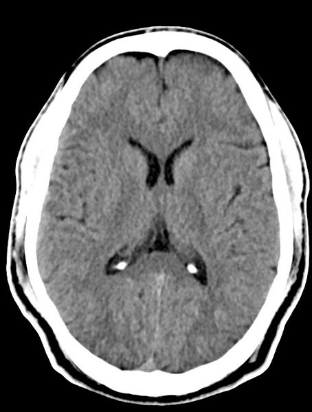 File:Cerebral venous angioma (Radiopaedia 69959-79977 Axial non-contrast 18).jpg