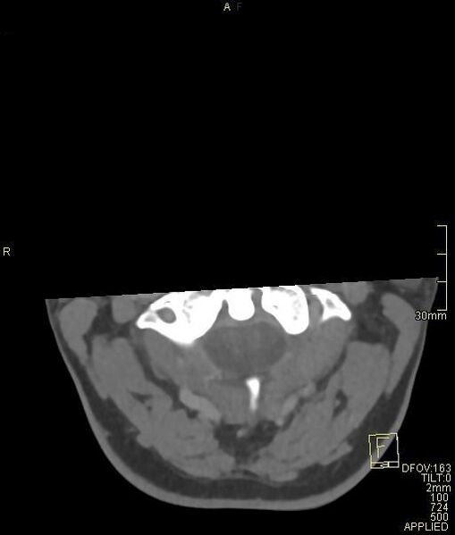 File:Cerebral venous sinus thrombosis (Radiopaedia 91329-108965 Axial venogram 2).jpg