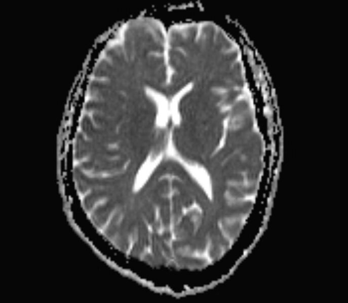File:Cerebral venous thrombosis (Radiopaedia 71207-81504 Axial ADC 11).jpg