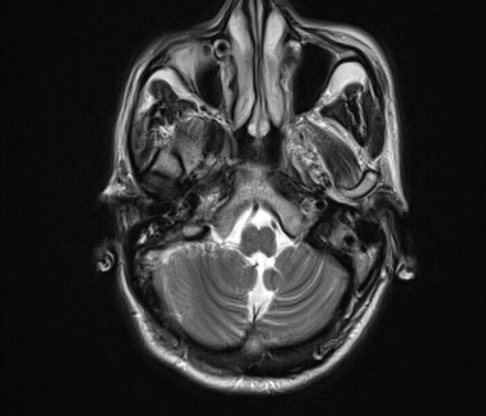 File:Cerebral venous thrombosis (Radiopaedia 71207-81504 Axial T2 6).jpg