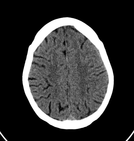 File:Cerebral venous thrombosis - CT only (Radiopaedia 41031-43778 Axial non-contrast 20).jpg