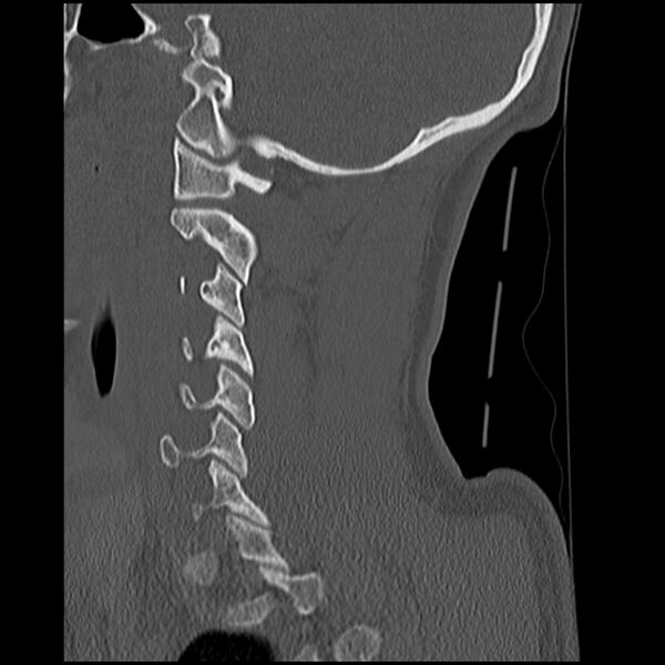 File:Cervical flexion teardrop fracture with cord hemorrhage (Radiopaedia 32497-33454 Sagittal bone window 13).jpg