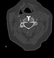 Cervical spine ACDF loosening (Radiopaedia 48998-54070 Axial bone window 29).png