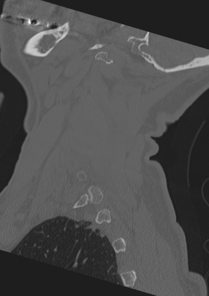 File:Cervical spine fractures with vertebral artery dissection (Radiopaedia 53296-59268 Sagittal bone window 60).png