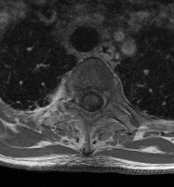 File:Cervical spondylodiscitis (Radiopaedia 81362-95110 Axial T1 C+ fat sat 24).jpg