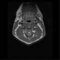Cervical vertebrae metastasis (Radiopaedia 78814-91667 Axial T1 1).png