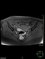 Cesarian scar endometriosis (Radiopaedia 68495-78066 Axial T1 fat sat 11).jpg
