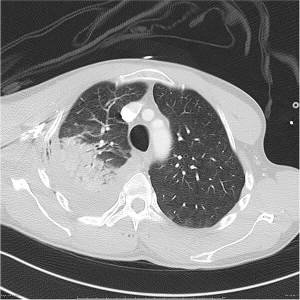 File:Chest and abdomen multi-trauma (Radiopaedia 26294-26425 lung window 34).jpg