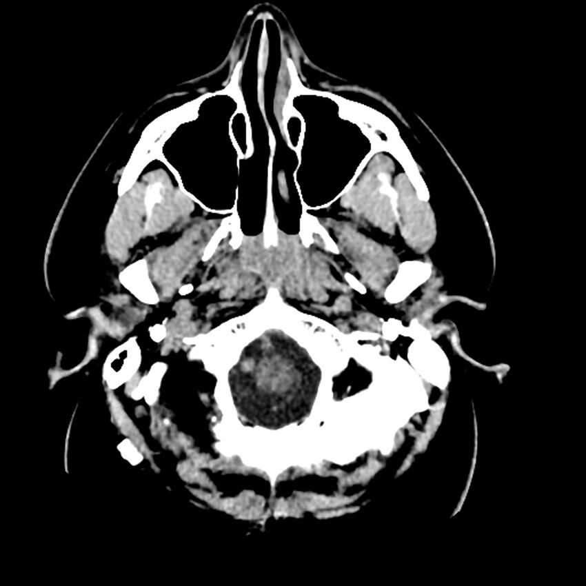 Chiasmatic-hypothalamic juvenile pilocytic astrocytoma (Radiopaedia 78533-91237 Axial non-contrast 9).jpg