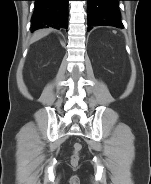 File:Cholecystitis with focal perforation and hepatic abscess (Radiopaedia 37189-38945 Coronal non-contrast 45).png