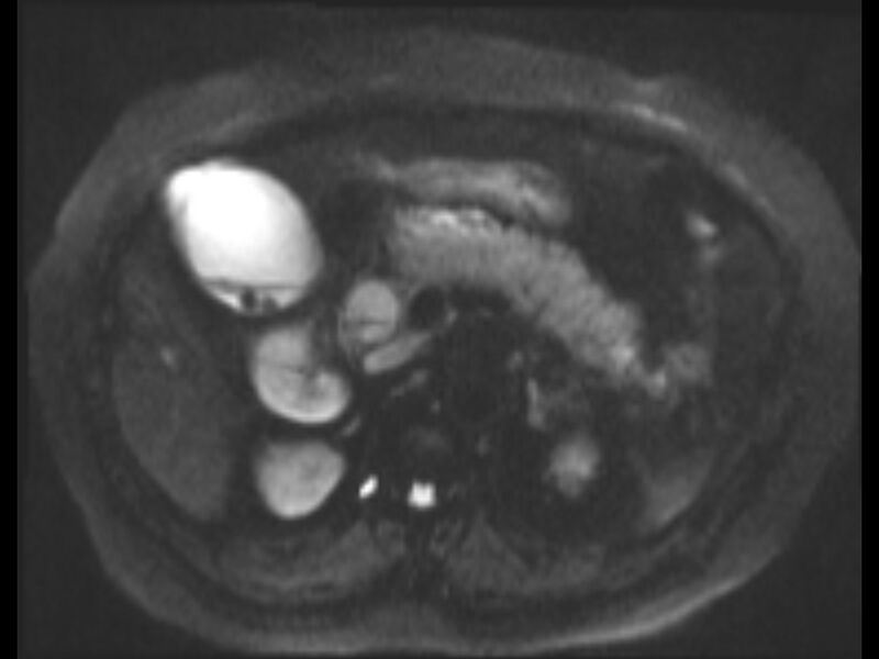 File:Choledocholithiasis causing intrahepatic biliary duct dilation (Radiopaedia 39908-42369 Axial T2 SPAIR 39).jpg