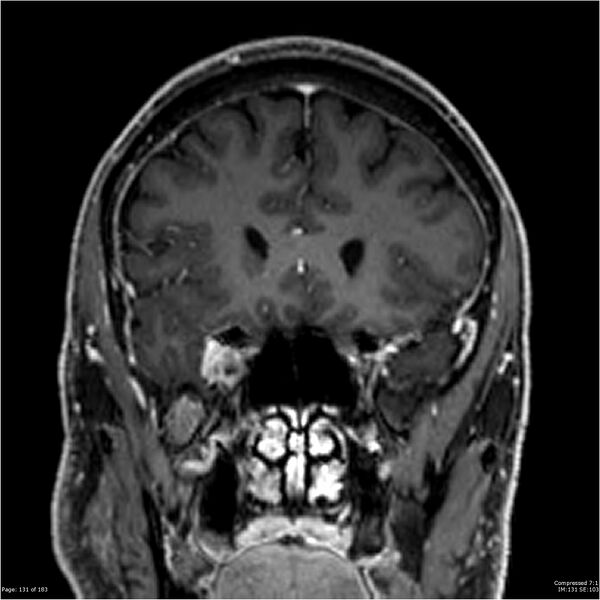 File:Chondrosarcoma of skull base- grade II (Radiopaedia 40948-43654 Coronal T1 C+ 42).jpg