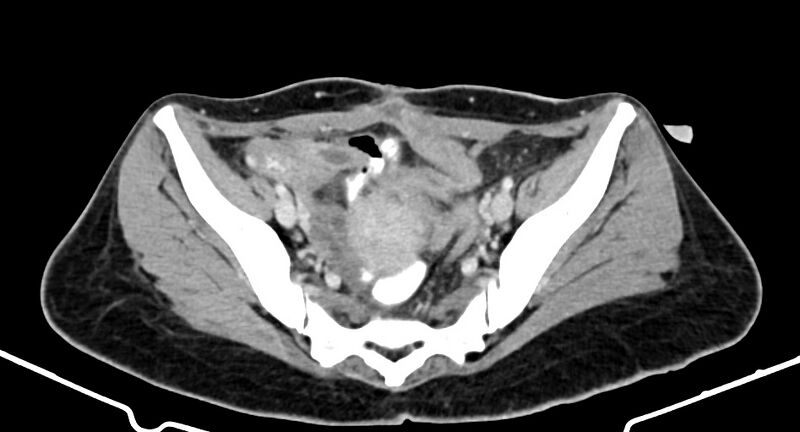 File:Choriocarcinoma liver metastases (Radiopaedia 74768-85766 A 169).jpg