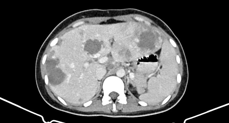 File:Choriocarcinoma liver metastases (Radiopaedia 74768-85766 A 64).jpg