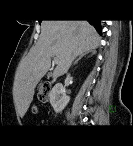 File:Chromophobe renal cell carcinoma (Radiopaedia 84239-99519 D 74).jpg