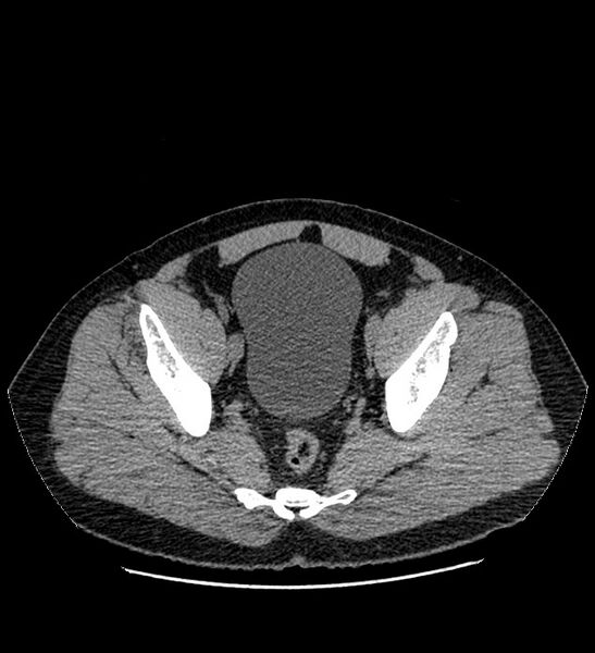 File:Chromophobe renal cell carcinoma (Radiopaedia 84337-99693 Axial non-contrast 137).jpg