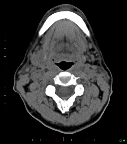File:Chronic Submandibular sialolithiasis (Radiopaedia 16880-16606 Axial non-contrast 17).jpg
