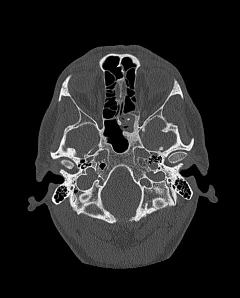 File:Chronic maxillary sinusitis caused by a foreign body (Radiopaedia 58521-65676 Axial bone window 213).jpg