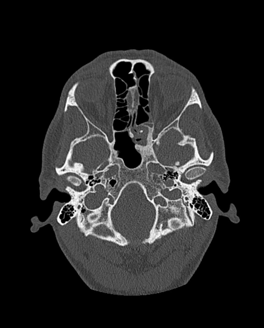 Chronic maxillary sinusitis caused by a foreign body (Radiopaedia 58521-65676 Axial bone window 213).jpg