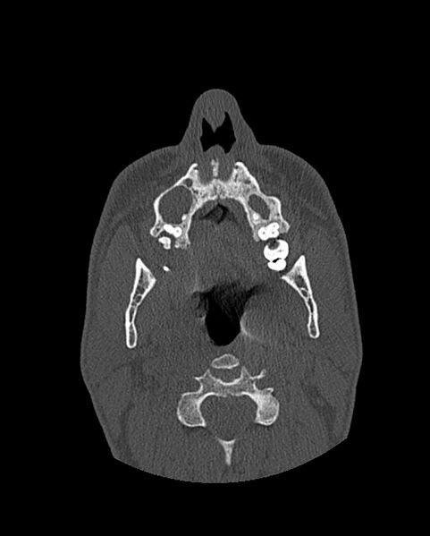 File:Chronic maxillary sinusitis caused by a foreign body (Radiopaedia 58521-65676 Axial bone window 49).jpg