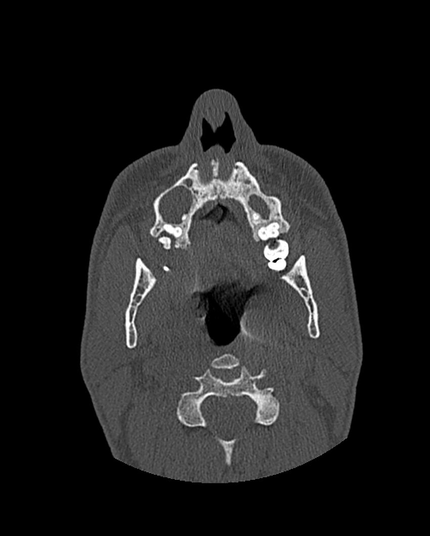 Chronic maxillary sinusitis caused by a foreign body (Radiopaedia 58521-65676 Axial bone window 49).jpg