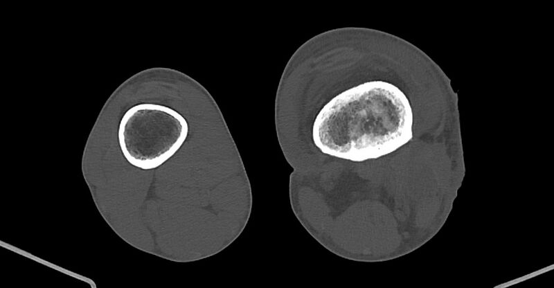 File:Chronic osteomyelitis (with sequestrum) (Radiopaedia 74813-85822 Axial non-contrast 160).jpg