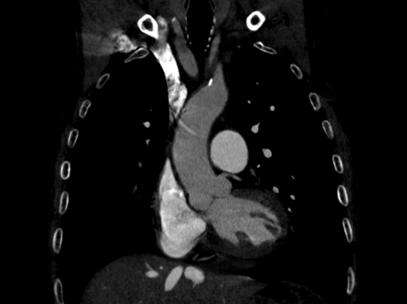 File:Chronic pulmonary embolism (Radiopaedia 91241-108843 A 37).jpg