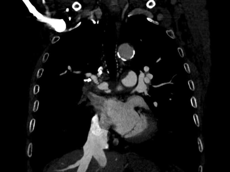 File:Chronic pulmonary embolism (Radiopaedia 91241-108843 A 51).jpg
