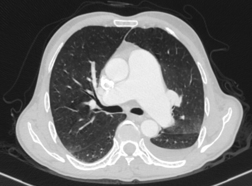 Chronic pulmonary embolism with bubbly consolidation (Radiopaedia 91248-108850 Axial lung window 71).jpg