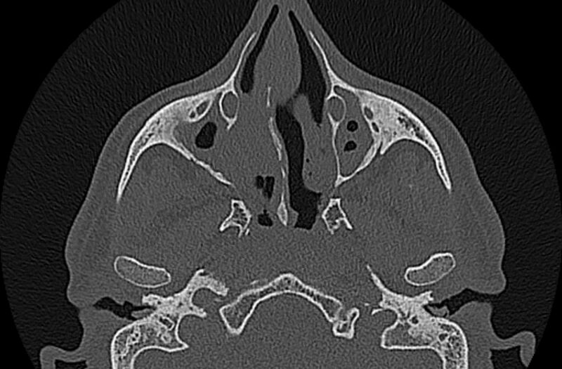 File:Chronic rhinosinusitis (Radiopaedia 65079-74075 Axial bone window 30).jpg