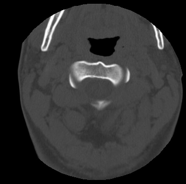 File:Clay-shoveler fracture (Radiopaedia 22568-22590 Axial bone window 15).jpg